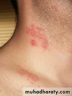 Infectious mononucleosis