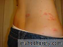 Infectious mononucleosis