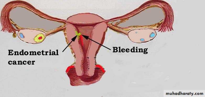 Abnormal uterine bleeding