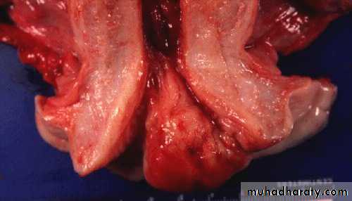 Abnormal uterine bleeding