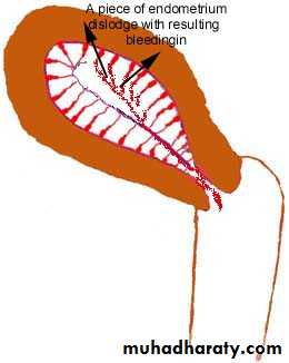 Abnormal uterine bleeding