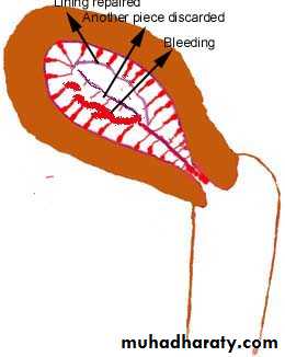Abnormal uterine bleeding
