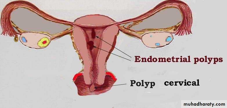 Abnormal uterine bleeding