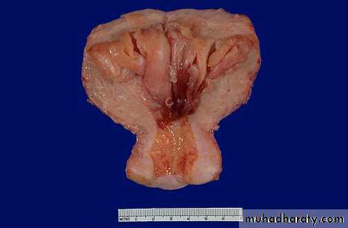 Abnormal uterine bleeding