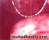 Abnormal uterine bleeding