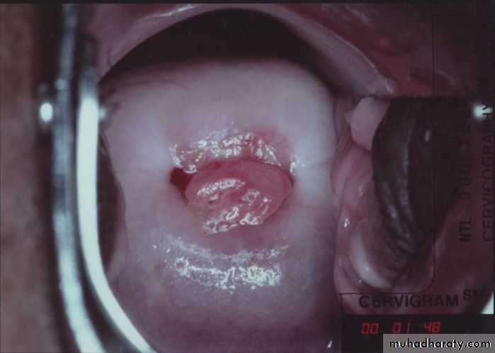 Abnormal uterine bleeding