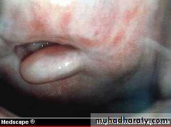 Abnormal uterine bleeding