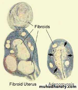 Abnormal uterine bleeding