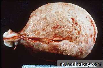 Abnormal uterine bleeding