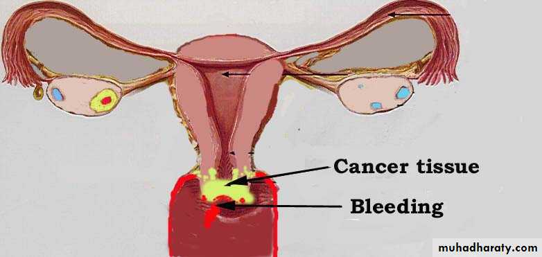 Abnormal uterine bleeding