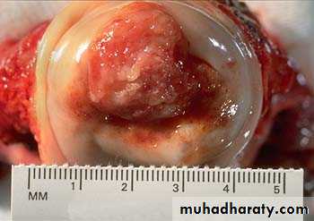 Abnormal uterine bleeding