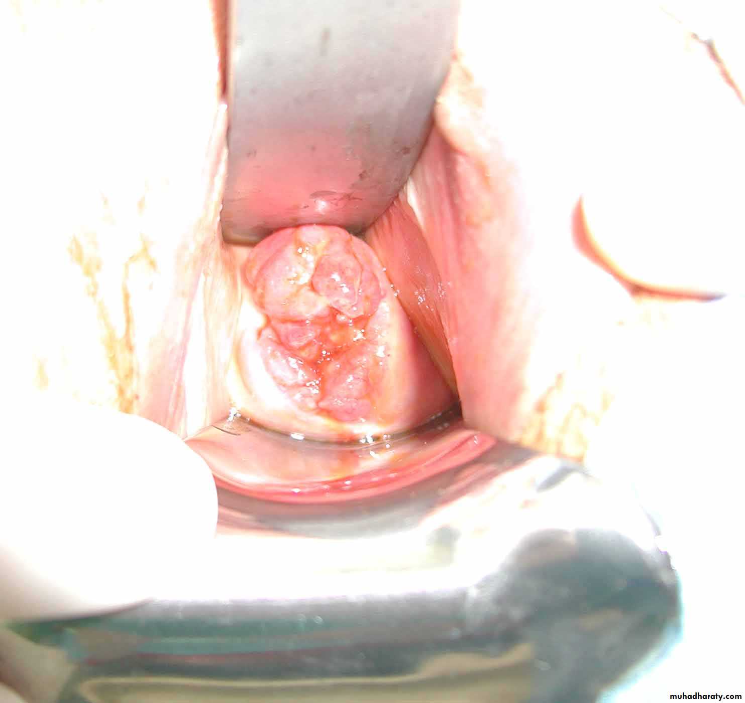 Cervical Cancer