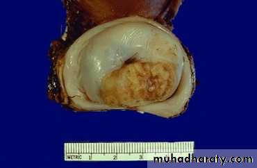 Cervical Cancer
