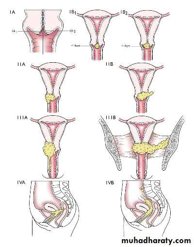 Cervical Cancer