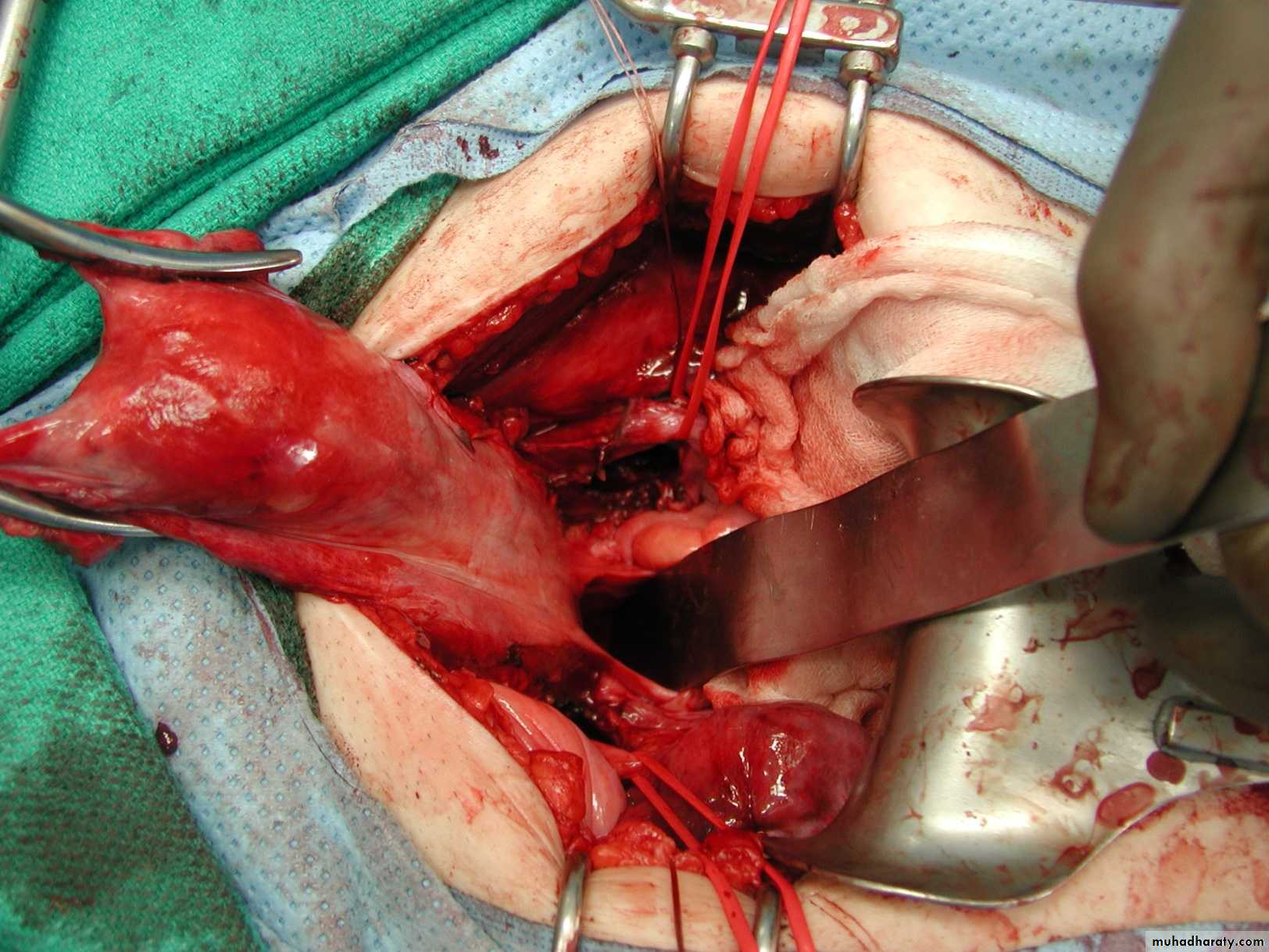 Cervical Cancer