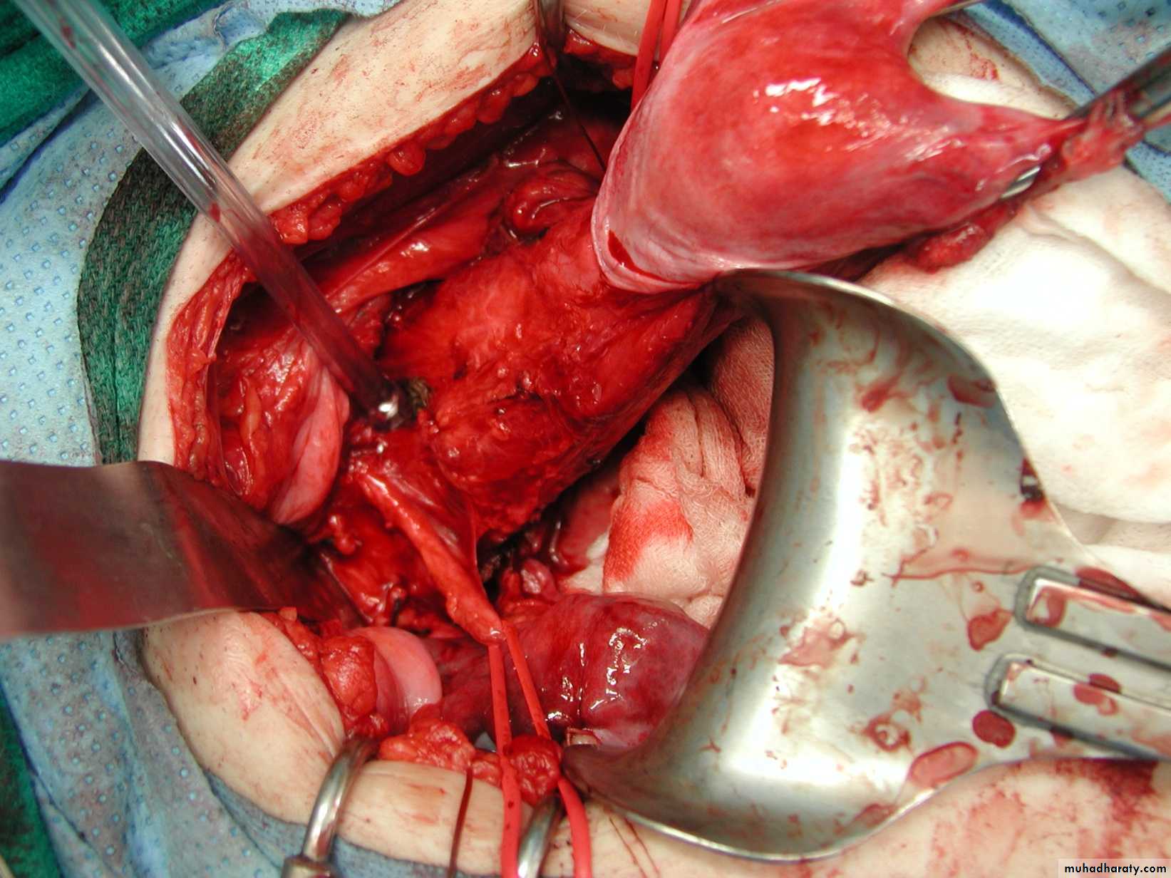Cervical Cancer
