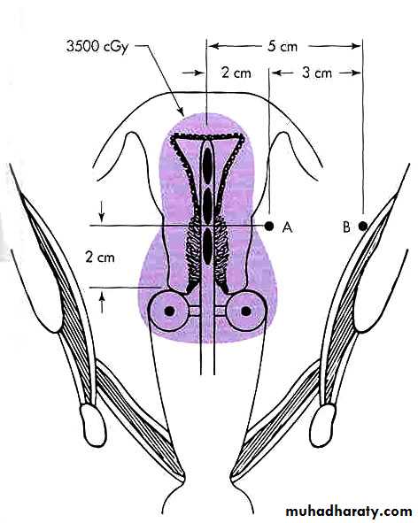 Cervical Cancer