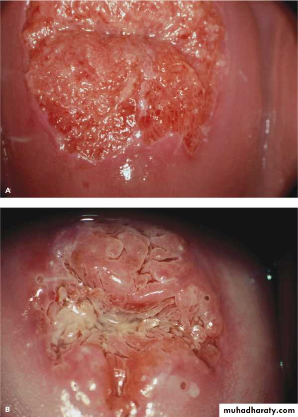 Premalignat disease