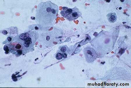 Premalignat disease