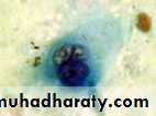 Premalignat disease