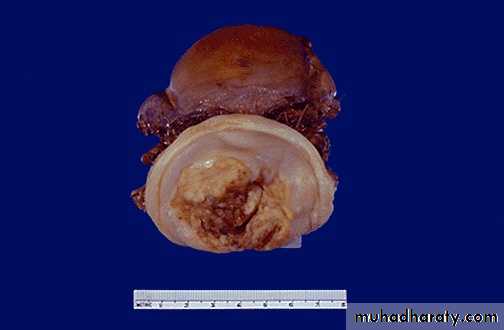 Premalignat disease