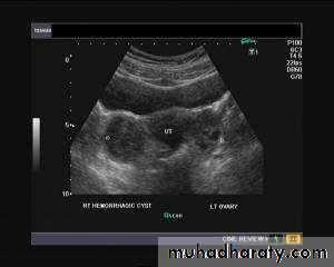 Ultrasonography in Gynaecology
