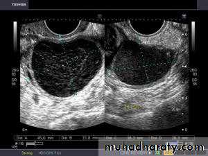 Ultrasonography in Gynaecology
