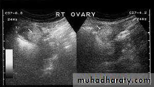 Ultrasonography in Gynaecology