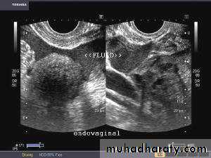 Ultrasonography in Gynaecology