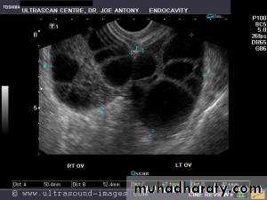 Ultrasonography in Gynaecology