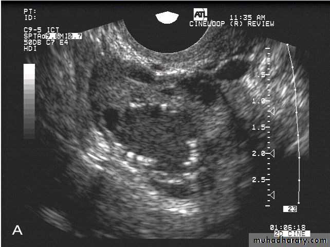 Ultrasonography in Gynaecology