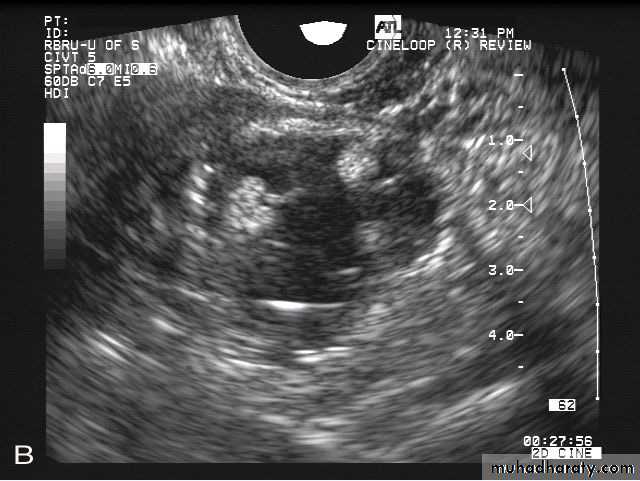 Ultrasonography in Gynaecology