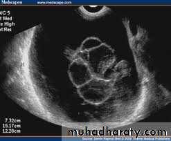 Ultrasonography in Gynaecology