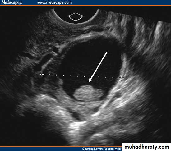 Ultrasonography in Gynaecology