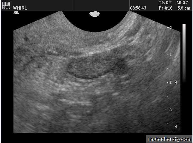 Ultrasonography in Gynaecology