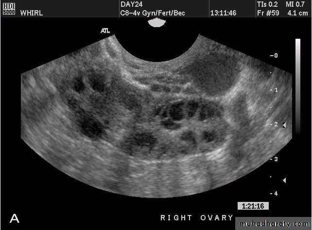 Ultrasonography in Gynaecology