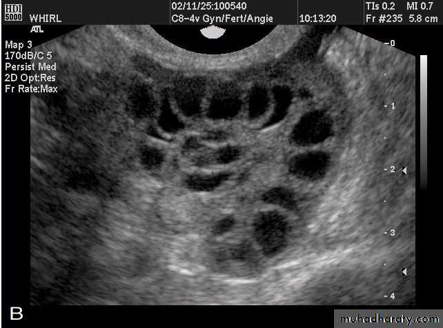 Ultrasonography in Gynaecology