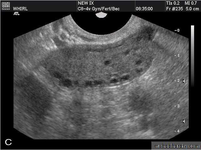 Ultrasonography in Gynaecology