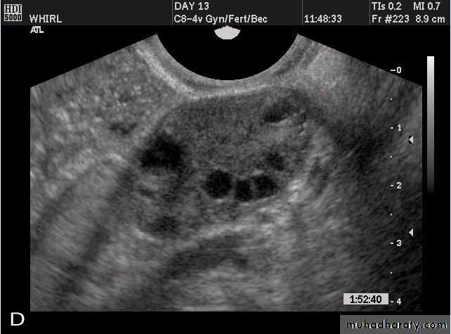 Ultrasonography in Gynaecology
