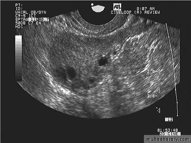 Ultrasonography in Gynaecology
