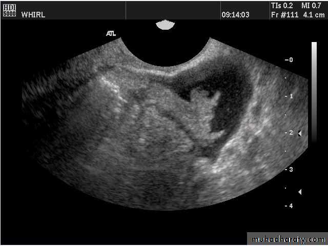 Ultrasonography in Gynaecology