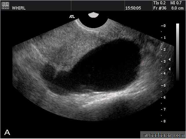 Ultrasonography in Gynaecology
