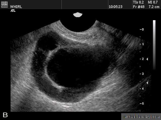 Ultrasonography in Gynaecology