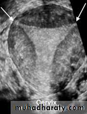 Ultrasonography in Gynaecology