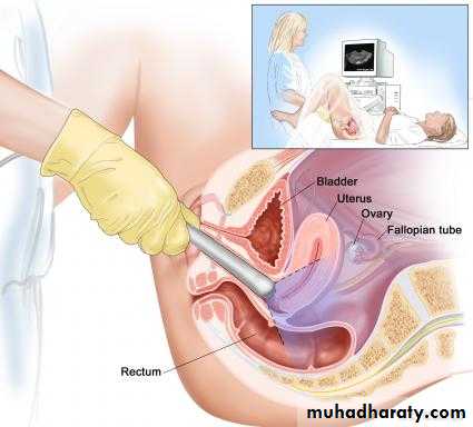 Ultrasonography in Gynaecology