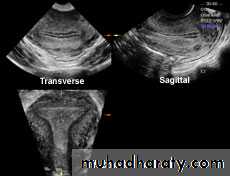 Ultrasonography in Gynaecology