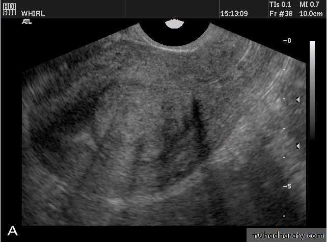 Ultrasonography in Gynaecology