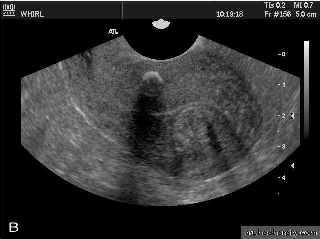 Ultrasonography in Gynaecology