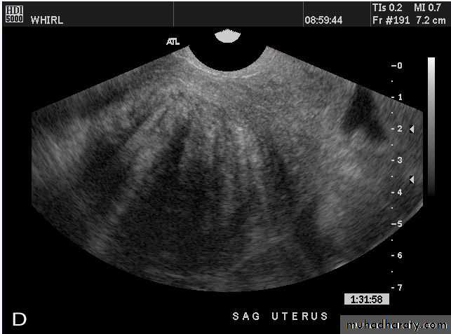 Ultrasonography in Gynaecology