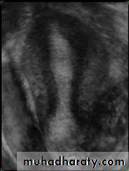 Ultrasonography in Gynaecology